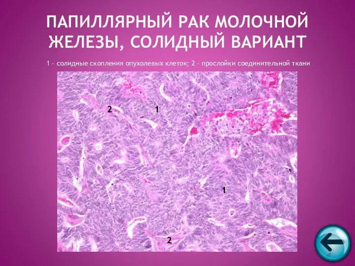 1 – солидные скопления опухолевых клеток; 2 – прослойки соединительной ткани