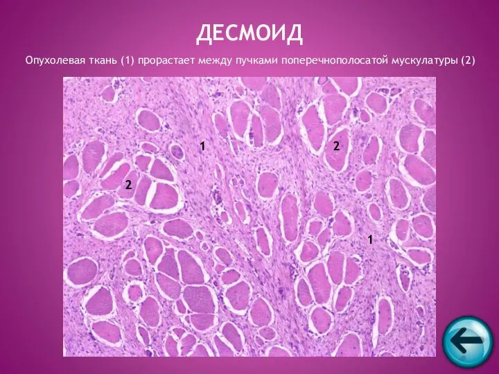ДЕСМОИД Опухолевая ткань (1) прорастает между пучками поперечнополосатой мускулатуры (2) 1 1 2 2