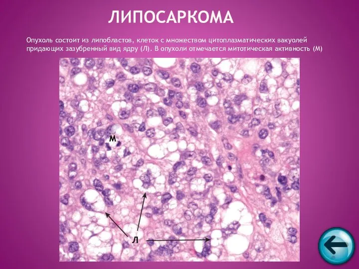 Опухоль состоит из липобластов, клеток с множеством цитоплазматических вакуолей придающих зазубренный