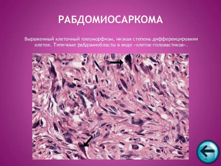 Выраженный клеточный плеоморфизм, низкая степень дифференцировкии клеток. Типичные рабдомиобласты в виде «клеток-головастиков». РАБДОМИОСАРКОМА