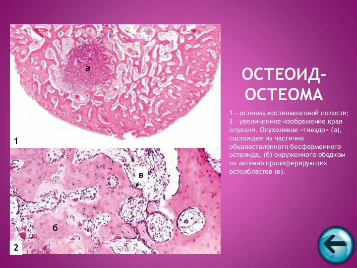 1 – остеома костномозговой полости; 2 – увеличенное изображение края опухоли.