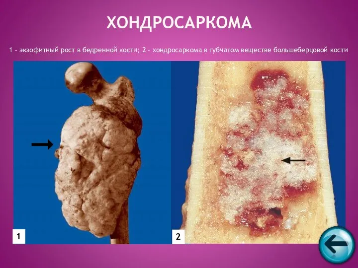 ХОНДРОСАРКОМА 1 – экзофитный рост в бедренной кости; 2 – хондросаркома