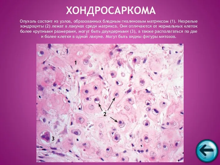Опухоль состоит из узлов, образованных бледным гиалиновым матриксом (1). Незрелые хондроциты