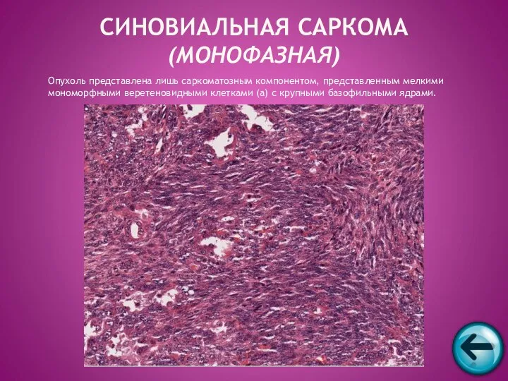 Опухоль представлена лишь саркоматозным компонентом, представленным мелкими мономорфными веретеновидными клетками (а)