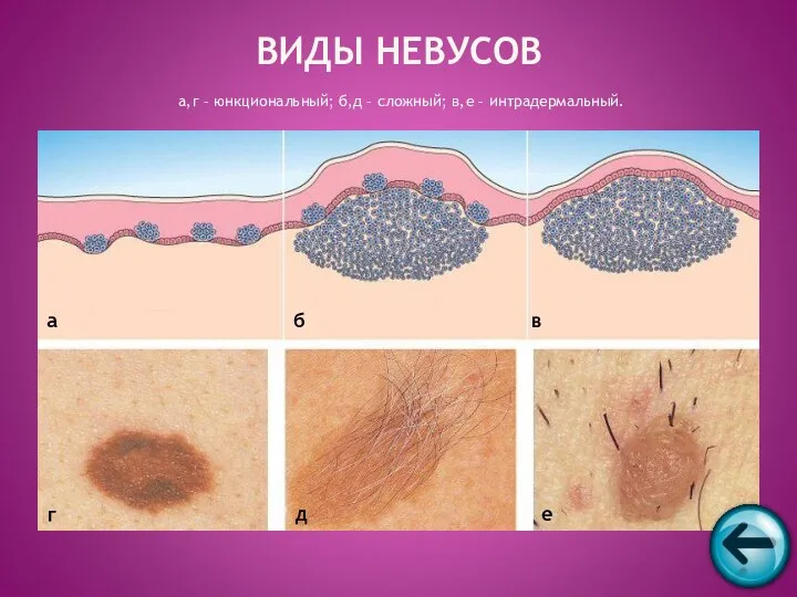 а,г – юнкциональный; б,д – сложный; в,е – интрадермальный. ВИДЫ НЕВУСОВ