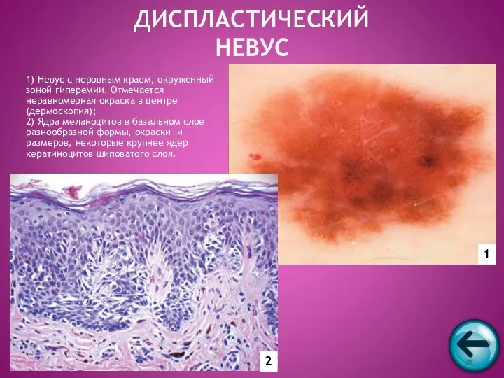 1) Невус с неровным краем, окруженный зоной гиперемии. Отмечается неравномерная окраска
