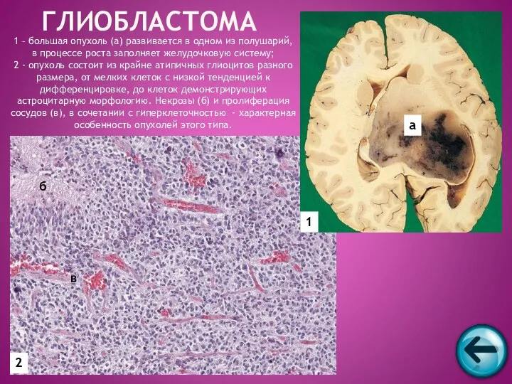 1 – большая опухоль (а) развивается в одном из полушарий, в