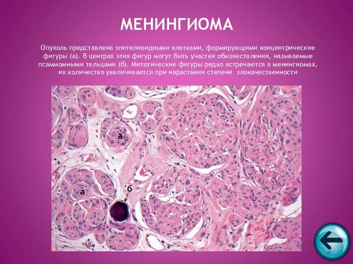 Опухоль представлена эпителиоидными клетками, формирующими концентрические фигуры (а). В центрах этих