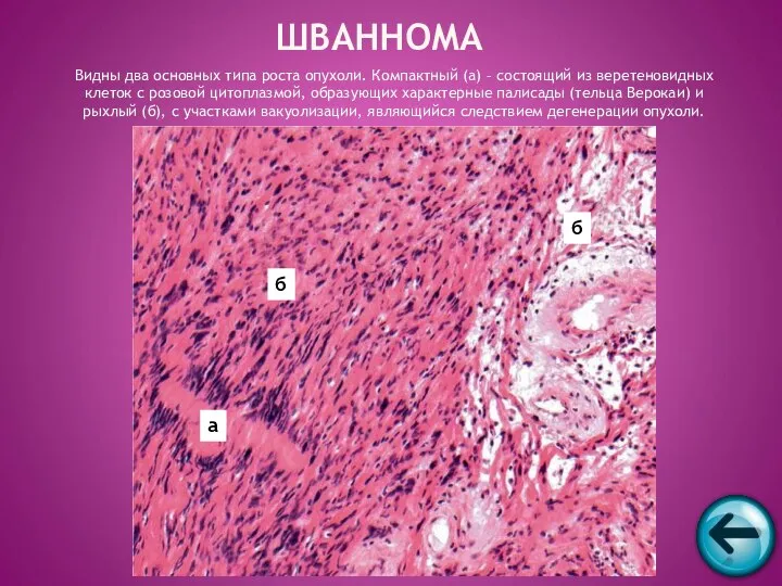 Видны два основных типа роста опухоли. Компактный (а) – состоящий из