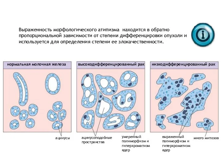 Выраженность морфологического атипизма находится в обратно пропорциональной зависимости от степени дифференцировки