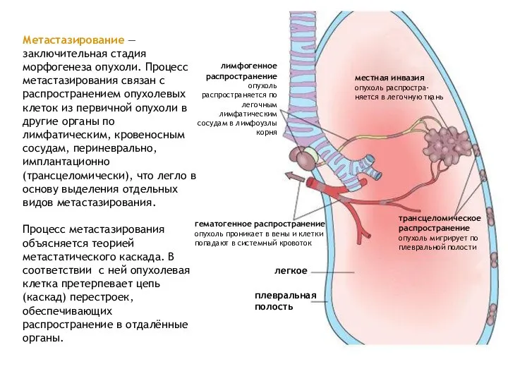 Метастазирование — заключительная стадия морфогенеза опухоли. Процесс метастазирования связан с распространением