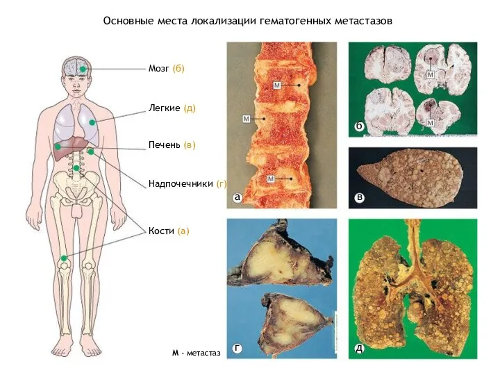 Основные места локализации гематогенных метастазов Мозг (б) Легкие (д) Печень (в)