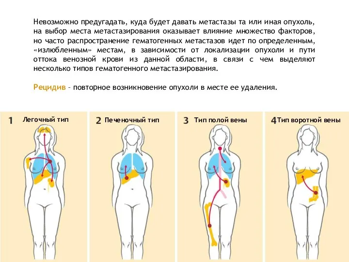 Невозможно предугадать, куда будет давать метастазы та или иная опухоль, на