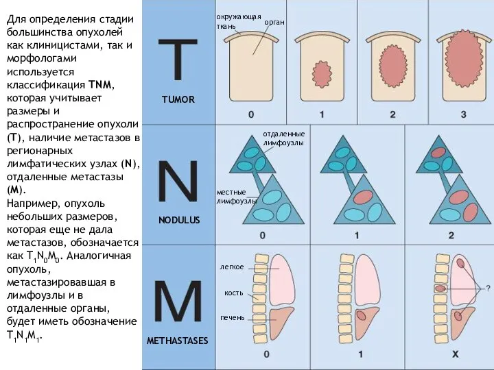 TUMOR NODULUS METHASTASES окружающая ткань орган отдаленные лимфоузлы местные лимфоузлы легкое