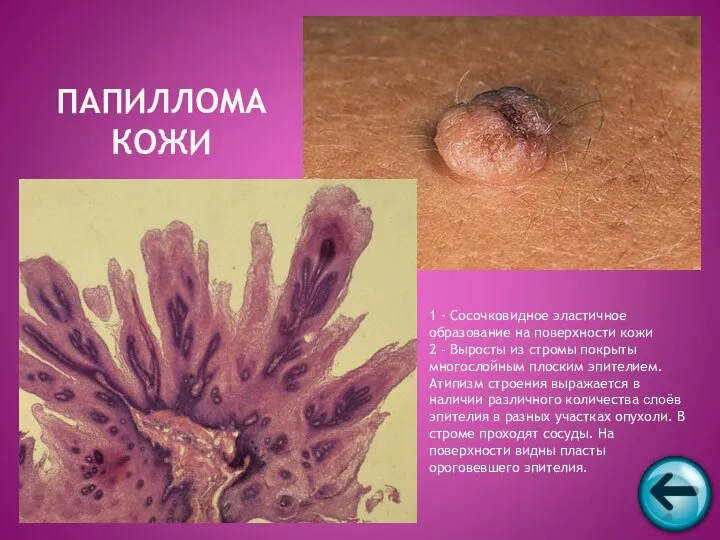 ПАПИЛЛОМА КОЖИ 1 - Сосочковидное эластичное образование на поверхности кожи 2