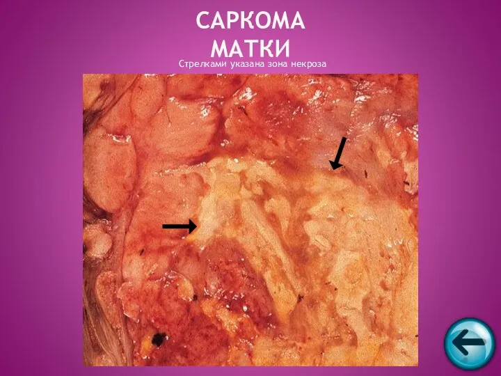 Стрелками указана зона некроза САРКОМА МАТКИ