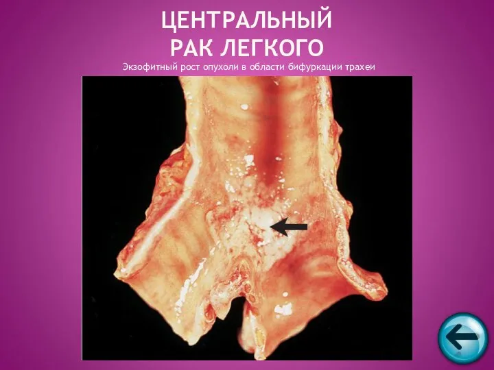 Экзофитный рост опухоли в области бифуркации трахеи ЦЕНТРАЛЬНЫЙ РАК ЛЕГКОГО