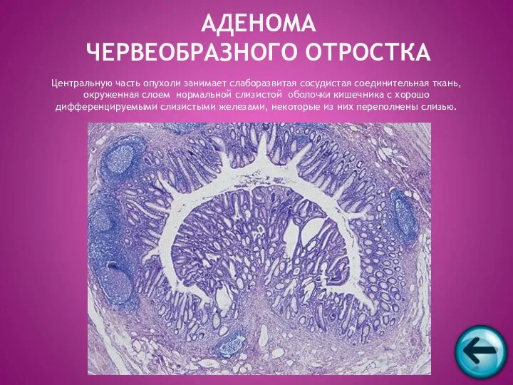 АДЕНОМА ЧЕРВЕОБРАЗНОГО ОТРОСТКА Центральную часть опухоли занимает слаборазвитая сосудистая соединительная ткань,