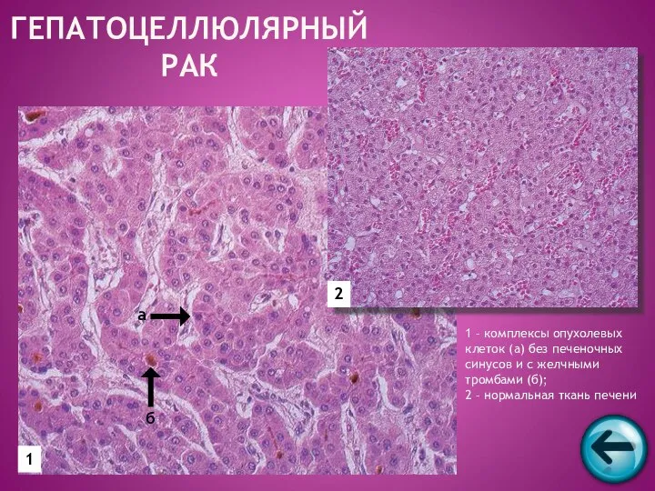 ГЕПАТОЦЕЛЛЮЛЯРНЫЙ РАК 1 2 а б 1 – комплексы опухолевых клеток