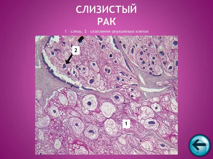 СЛИЗИСТЫЙ РАК 1 – слизь; 2 – скопления опухолевых клеток 1 2