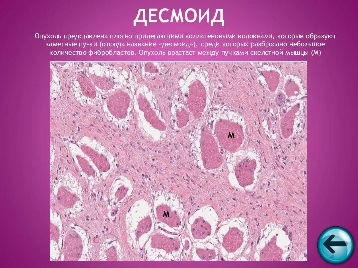 ДЕСМОИД Опухоль представлена плотно прилегающими коллагеновыми волокнами, которые образуют заметные пучки