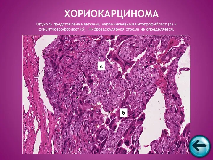 ХОРИОКАРЦИНОМА Опухоль представлена клетками, напоминающими цитотрофибласт (а) и синцитиотрофобласт (б). Фиброваскулярная строма не определяется. а б