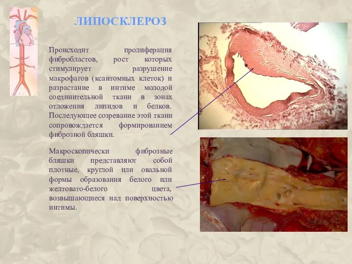 ЛИПОСКЛЕРОЗ Происходит пролиферация фибробластов, рост которых стимулирует разрушение макрофагов (ксантомных клеток)