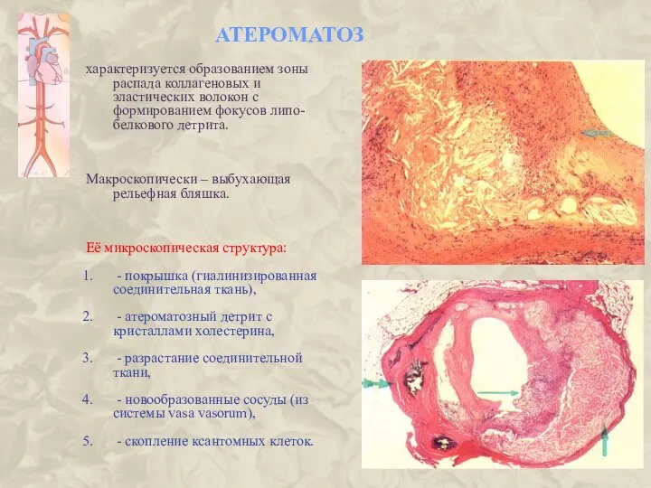 АТЕРОМАТОЗ характеризуется образованием зоны распада коллагеновых и эластических волокон с формированием