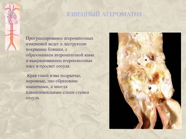 ЯЗВЕННЫЙ АТЕРОМАТОЗ Прогрессирование атероматозных изменений ведет к деструкции покрышки бляшки, с