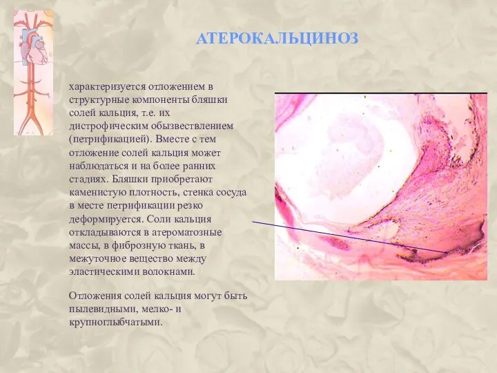 АТЕРОКАЛЬЦИНОЗ характеризуется отложением в структурные компоненты бляшки солей кальция, т.е. их