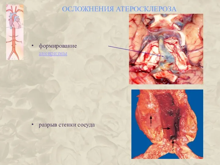 ОСЛОЖНЕНИЯ АТЕРОСКЛЕРОЗА формирование аневризмы разрыв стенки сосуда