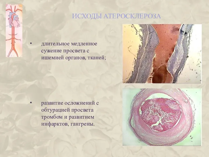 ИСХОДЫ АТЕРОСКЛЕРОЗА длительное медленное сужение просвета с ишемией органов, тканей; развитие