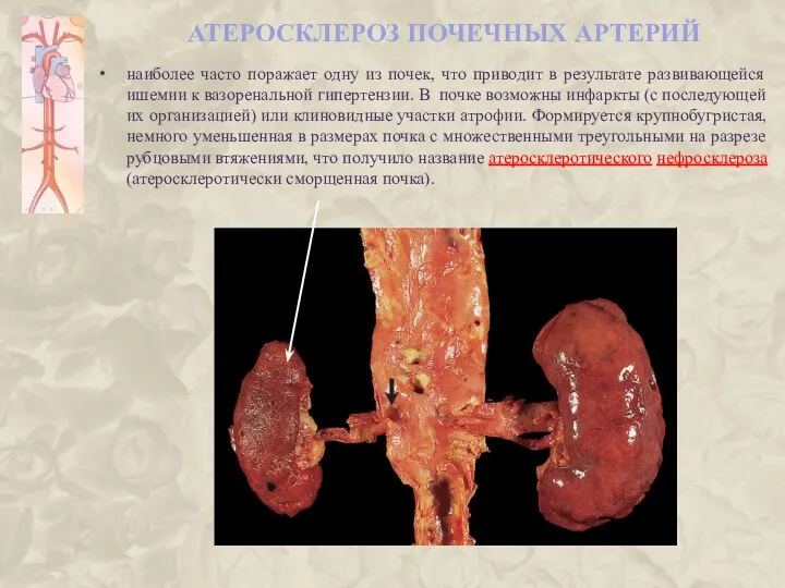 АТЕРОСКЛЕРОЗ ПОЧЕЧНЫХ АРТЕРИЙ наиболее часто поражает одну из почек, что приводит