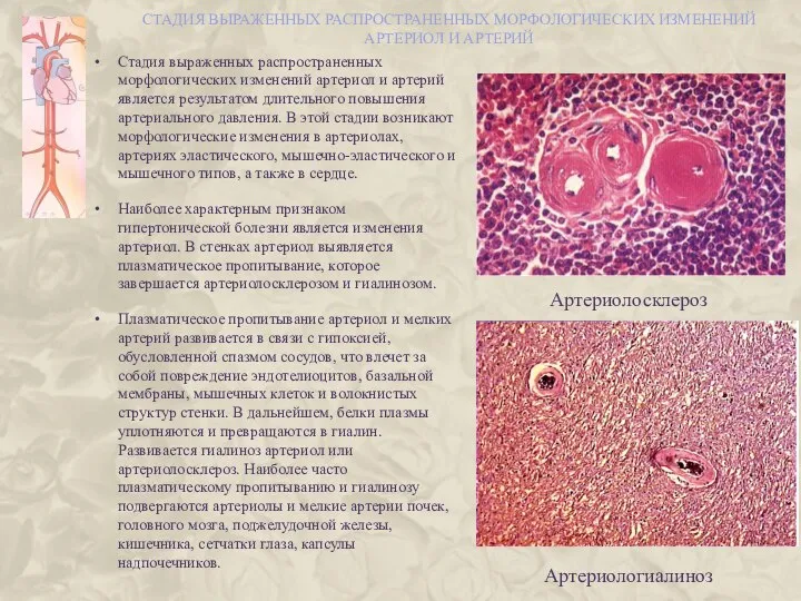 СТАДИЯ ВЫРАЖЕННЫХ РАСПРОСТРАНЕННЫХ МОРФОЛОГИЧЕСКИХ ИЗМЕНЕНИЙ АРТЕРИОЛ И АРТЕРИЙ Стадия выраженных распространенных