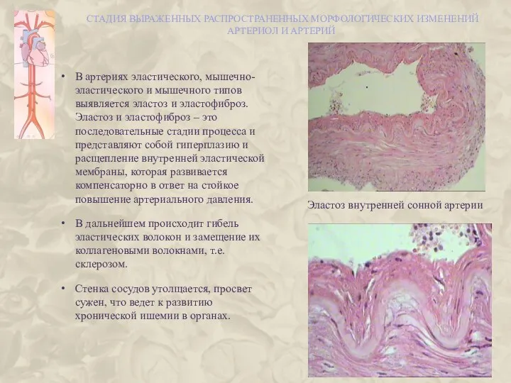 СТАДИЯ ВЫРАЖЕННЫХ РАСПРОСТРАНЕННЫХ МОРФОЛОГИЧЕСКИХ ИЗМЕНЕНИЙ АРТЕРИОЛ И АРТЕРИЙ В артериях эластического,