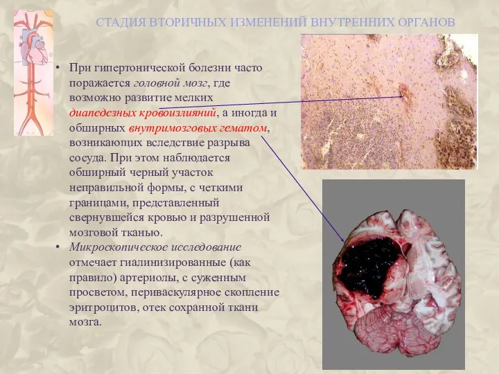 СТАДИЯ ВТОРИЧНЫХ ИЗМЕНЕНИЙ ВНУТРЕННИХ ОРГАНОВ При гипертонической болезни часто поражается головной