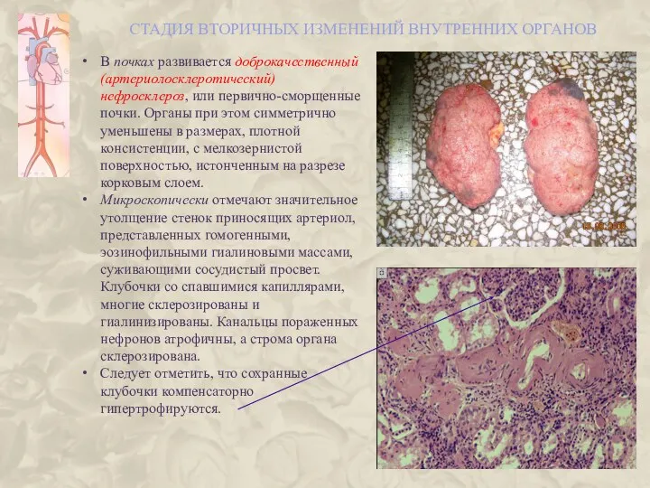 СТАДИЯ ВТОРИЧНЫХ ИЗМЕНЕНИЙ ВНУТРЕННИХ ОРГАНОВ В почках развивается доброкачественный (артериолосклеротический) нефросклероз,