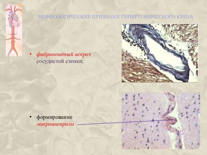 МОРФОЛОГИЧЕСКИЕ ПРИЗНАКИ ГИПЕРТОНИЧЕСКОГО КРИЗА фибриноидный некроз сосудистой стенки; формирование микроаневризм