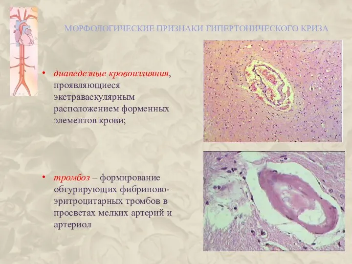 МОРФОЛОГИЧЕСКИЕ ПРИЗНАКИ ГИПЕРТОНИЧЕСКОГО КРИЗА диапедезные кровоизлияния, проявляющиеся экстраваскулярным расположением форменных элементов