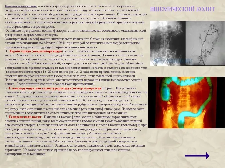 ИШЕМИЧЕСКИЙ КОЛИТ Ишемический колит – особая форма нарушения кровотока в системе