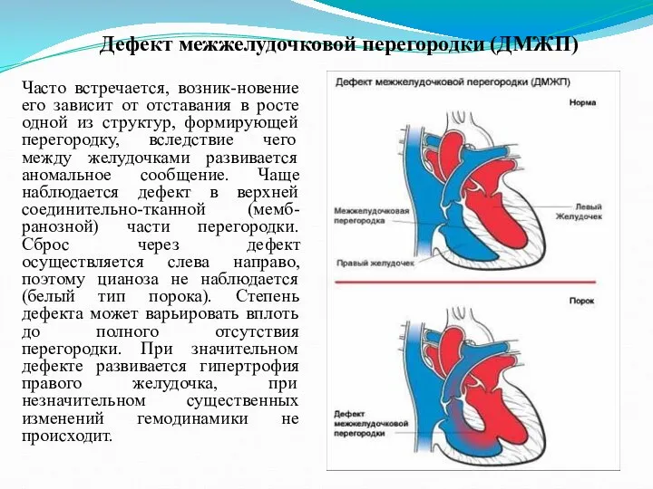 Дефект межжелудочковой перегородки (ДМЖП) Часто встречается, возник-новение его зависит от отставания