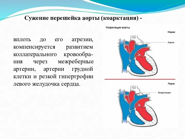 Сужение перешейка аорты (коарктация) - вплоть до его атрезии, компенсируется развитием