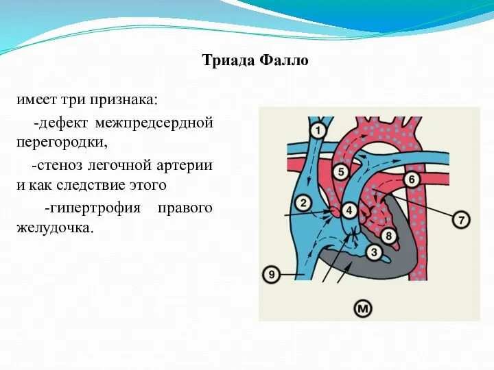 Триада Фалло имеет три признака: -дефект межпредсердной перегородки, -стеноз легочной артерии