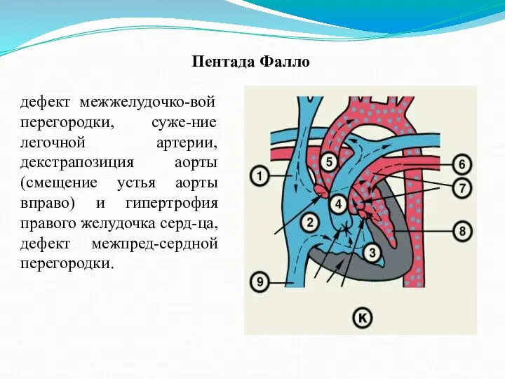 Пентада Фалло дефект межжелудочко-вой перегородки, суже-ние легочной артерии, декстрапозиция аорты (смещение