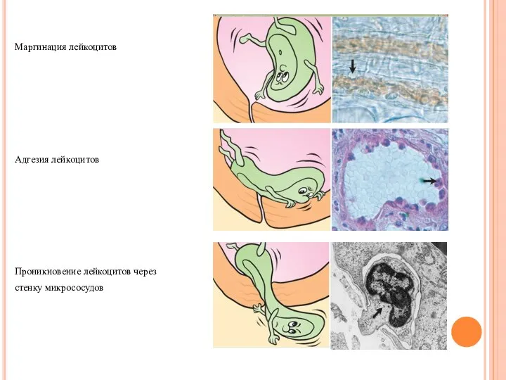 Маргинация лейкоцитов Адгезия лейкоцитов Проникновение лейкоцитов через стенку микрососудов