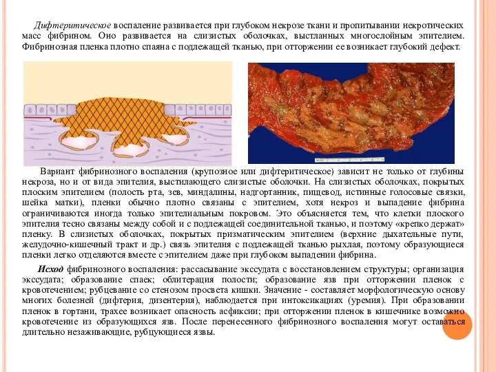 Дифтеритическое воспаление развивается при глубоком некрозе ткани и пропитывании некротических масс