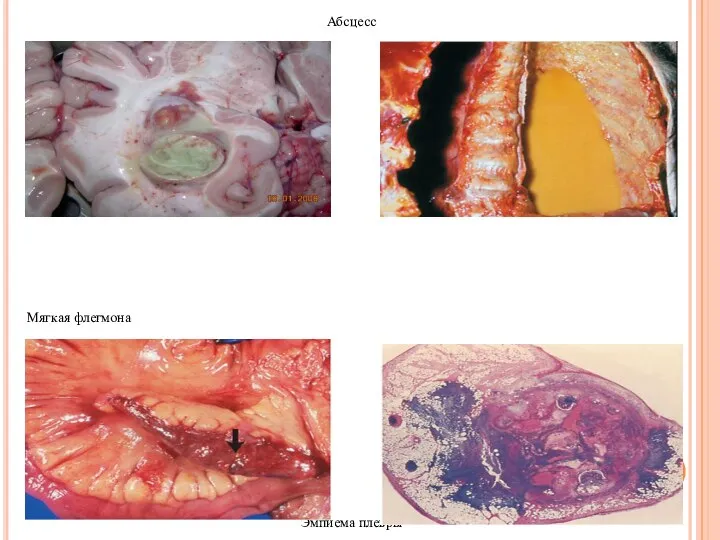 Абсцесс Мягкая флегмона Эмпиема плевры Твердая флегмона