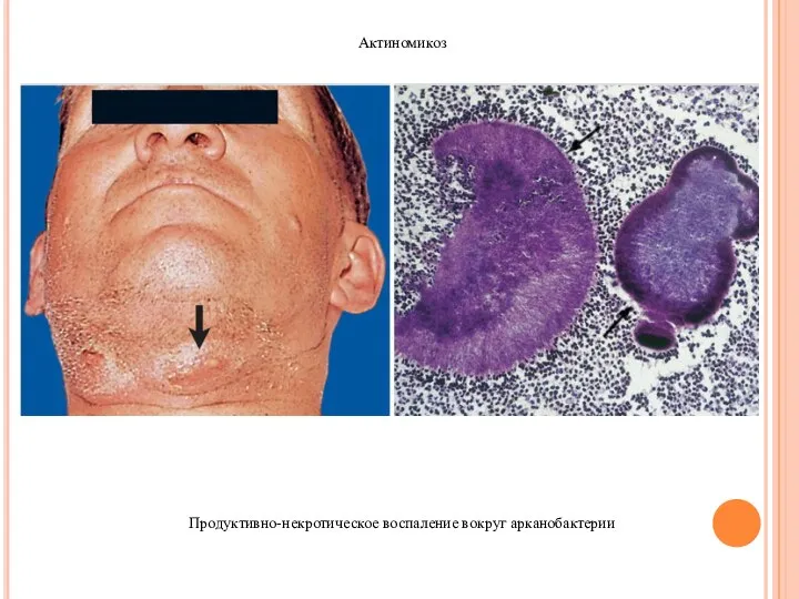 Актиномикоз Продуктивно-некротическое воспаление вокруг арканобактерии