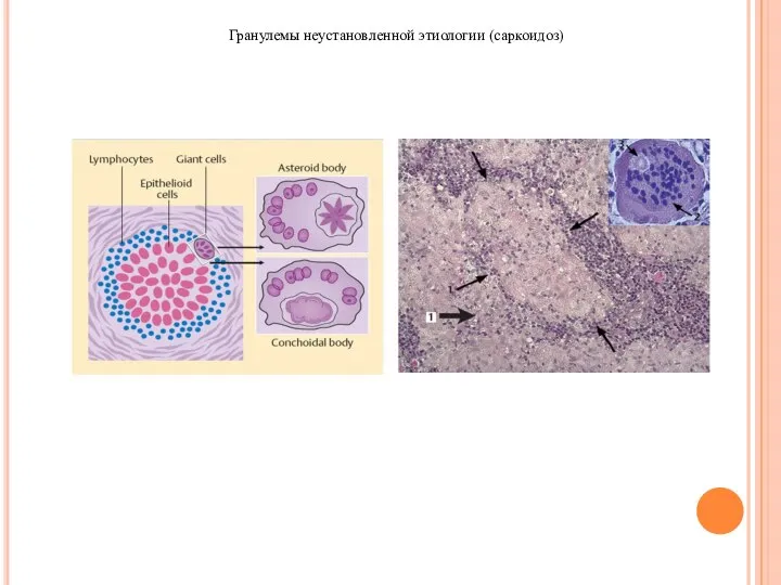 Гранулемы неустановленной этиологии (саркоидоз)