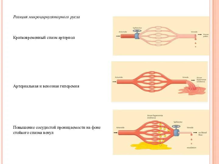 Реакция микроциркуляторного русла Кратковременный спазм артериол Артериальная и венозная гиперемия Повышение